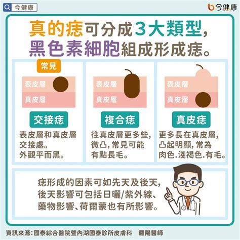 凸痣長毛|痣長毛=皮膚癌？醫解惑